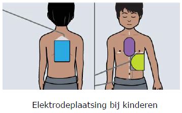 Plaatsing van kinderelektroden