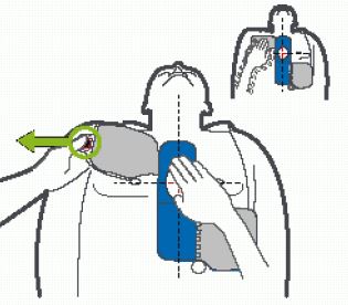 Plaatsing Zoll CPR-D elektroden