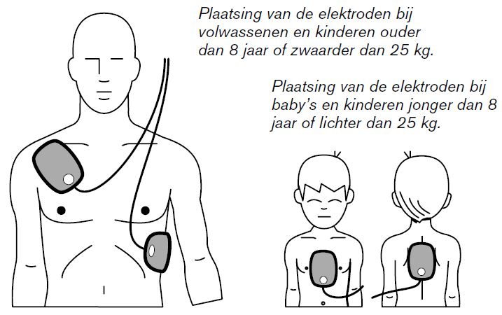 Platsing elektroden HS1