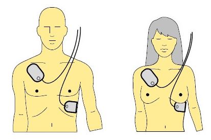 Hoe plak je de elektroden van de AED?